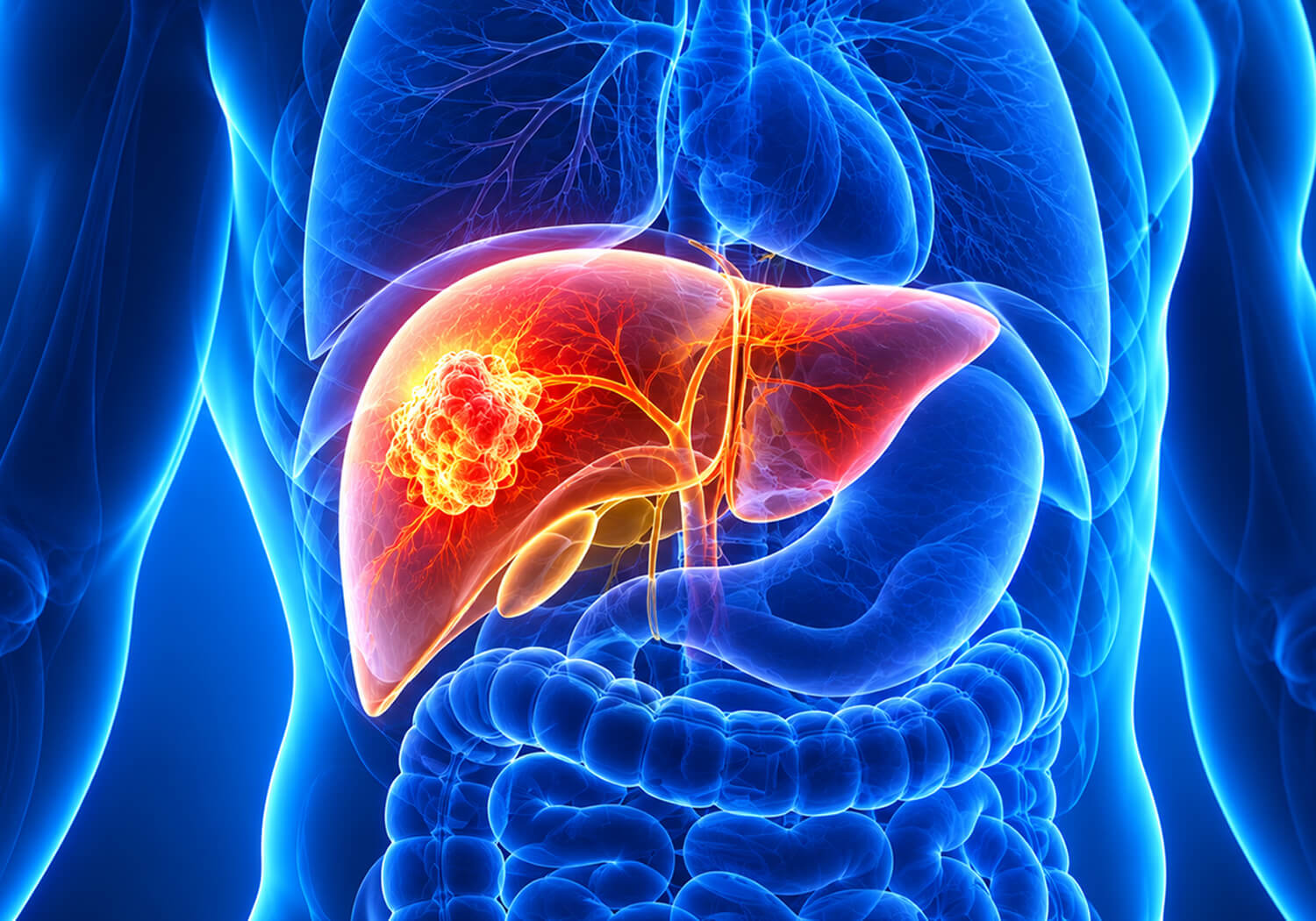 Liver Cancer