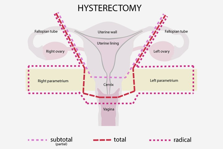 Hysterectomy