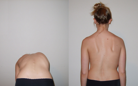 Scoliosis: علامات اعوجاج العمود الفقري التي تجعل الأهل ينتبهون