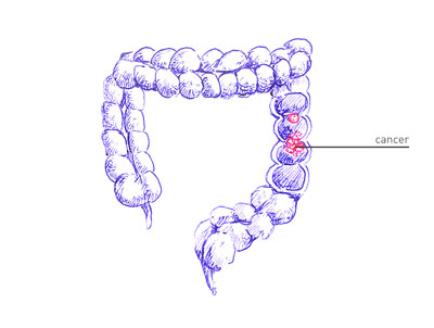 Colorectal Cancer