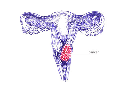 Cervical Cancer