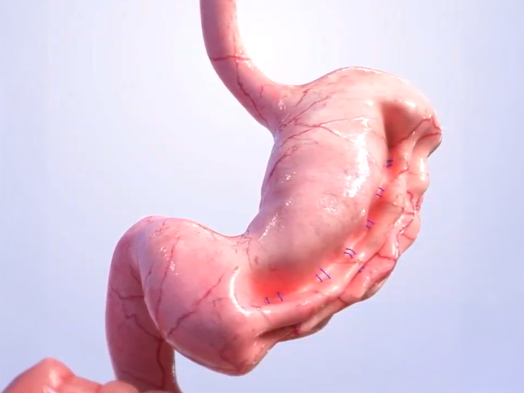 Endoscopic Sleeve Gastroplasty (ESG) procedure shrinks stomach volume promoting earlier and lasting fullness 