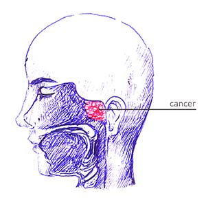 Nasopharyngeal Cancer