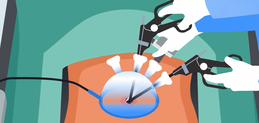 Single-Port Surgery is performed via a small opening via the belly button