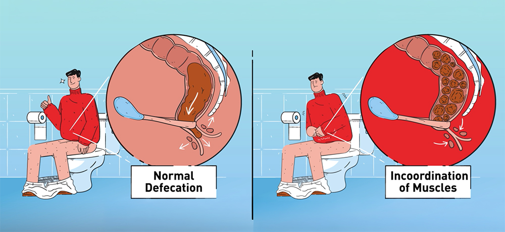 What Causes Evacuation