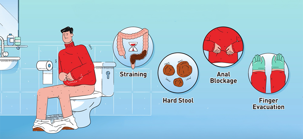 what is constipation