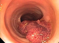 colon polyp