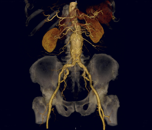 Abdominal Aortic Aneurysm (AAA)