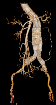 Abdominal Aortic Aneurysm (AAA)