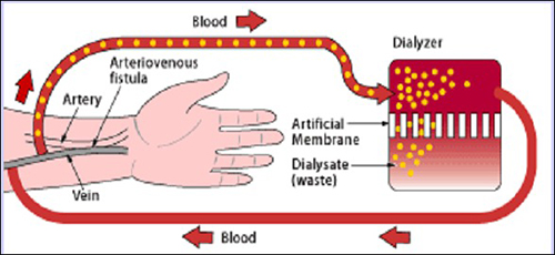 Arteriovenous fistula