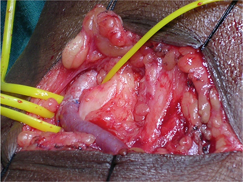 Arteriovenous fistula