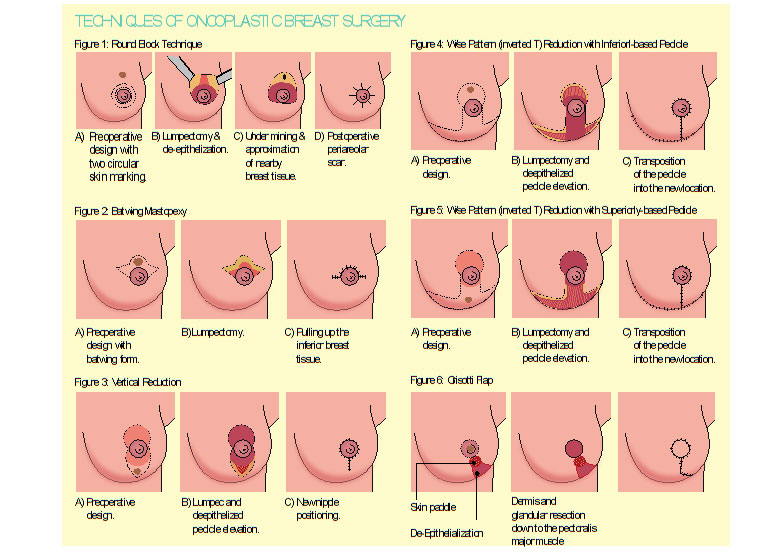 乳腺癌——你需要知道的