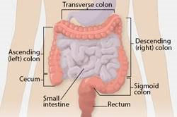 Colorectal Cancer Rates Rising in Young Adults