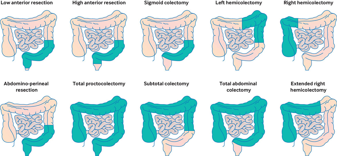 Colorectal Cancer Rates Rising in Young Adults