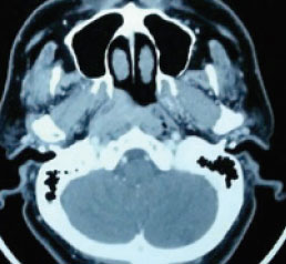 Understanding Nasopharyngeal Cancer (NPC)