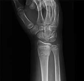 This is an X-ray image of a wrist bone fracture. A bone fracture can be detrimental if left untreated. A bone surgeon or orthopedic doctor or bone specialist or orthopedic surgeon or orthopedic specialist can help remedy this hairline fracture. The bone healing process may take some time and you may be put in a plaster cast for the bone fracture healing. 