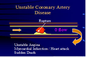 Am I at Risk From Heart Disease?