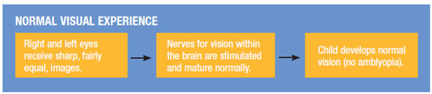 Lazy Eye (Amblyopia) - What's That?