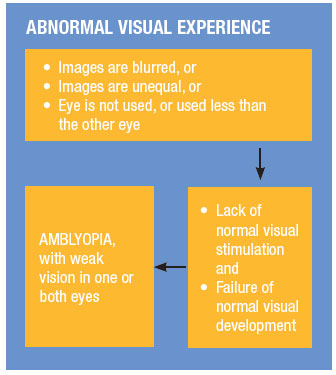 Lazy Eye (Amblyopia) - What's That?