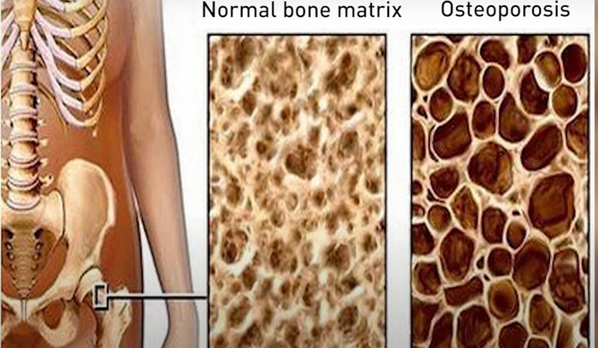 Osteoporosis