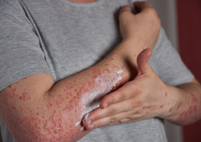 Symptoms of Psoriasis