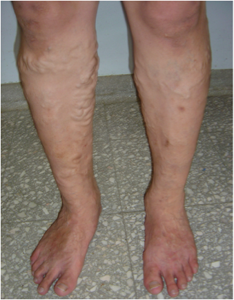 Surgery for Lower Limb Varicose Veins