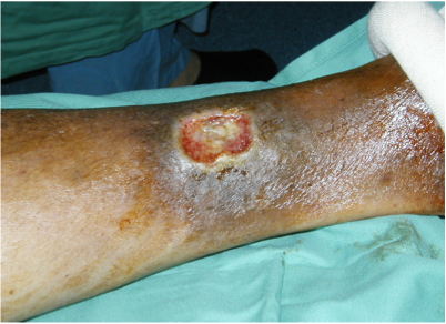 Varicose Veins