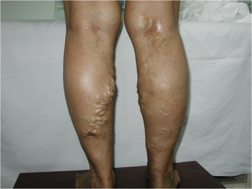 Varicose Veins