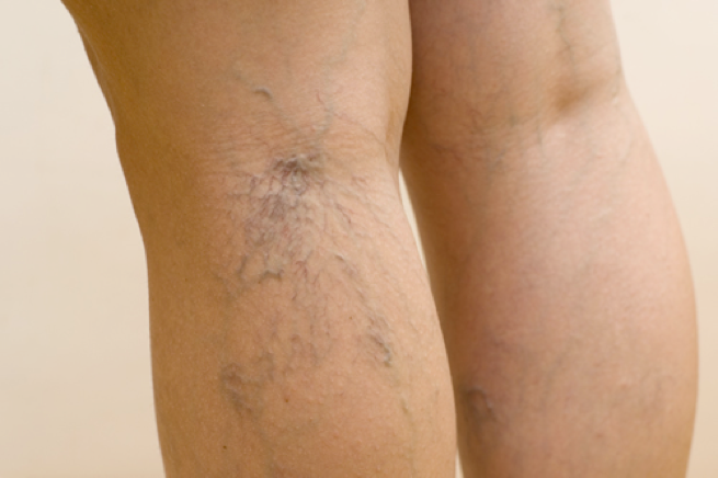 Varicose Veins