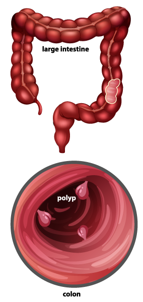 Polyps