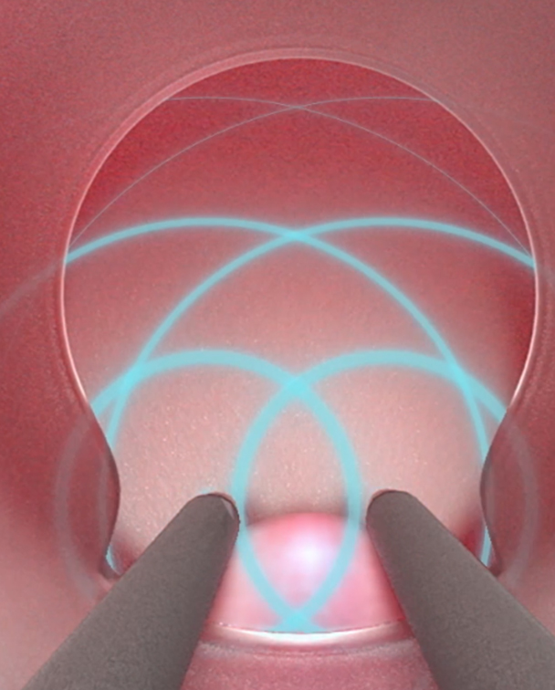 eXroid Haemorrhoid Electrotherapy Treatment