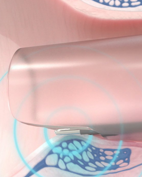 eXroid Haemorrhoid Electrotherapy Treatment 2