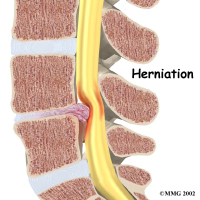 Illustration showing lumbar disc prolapse and nerve compression