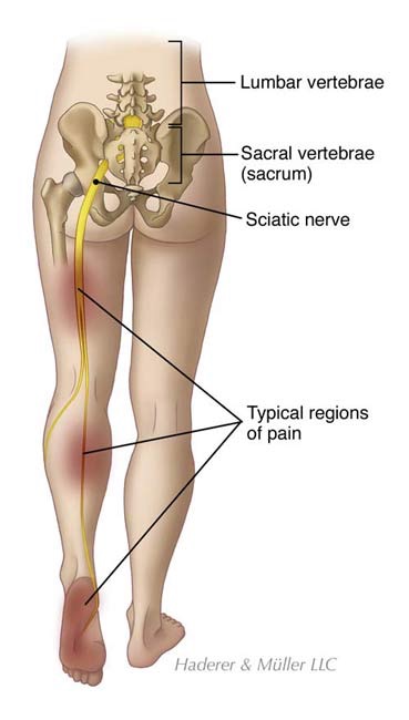 Typical pain during the lumbar slipped disc with nerve compression