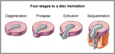 Various severity of lumbar disc prolapse