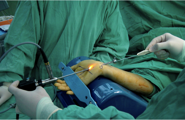 Endoscopic carpal tunnel