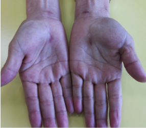 Arrows showing the endoscopic surgical scars on both hands