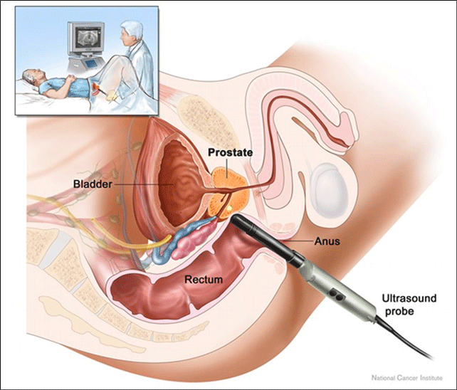 Prostate Cancer