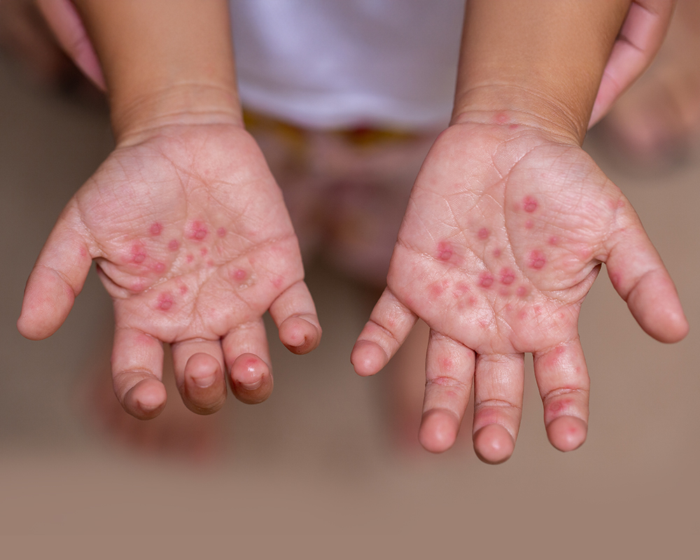 hand foot mouth disease (HFMD)