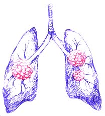 Lung Cancer